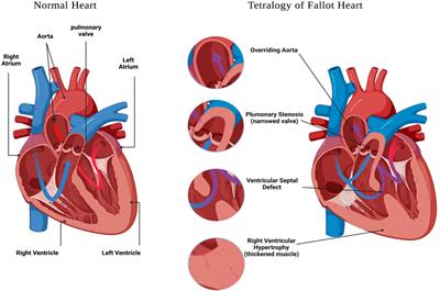 Genetic insights into non-syndromic Tetralogy of Fallot